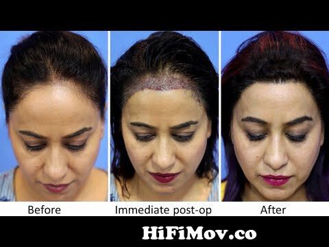 Female Hair Transplant Clinic in Mumbai, | Before and After Result |  @EugenixHairSciencesofficial from india mumbai women hair cut Watch Video -  