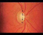 Oculus: Learn Ophthalmology