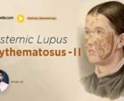 Systemic Lupus Erythematosus is a very extensive topic, so Dr. Ali Imran divided this topic in two Rheumatology lectures online. In the first lecture SLE pathogenesis, Pathology of lupus and systemic lupus erythematosus risk factor are explained. While in this lecture systemic lupus erythematosus differential diagnosis and management is discussed in detail.nn-------------------------------------------------------------nLecture Duration - 01:01:24nRelease Date - January 2020nnWatch complete lectu