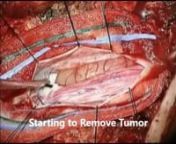 Spinal cord tumors are rare but can cause significant neurologically and functionally impaired. Microsurgical techniques and other specialized treatments are used to remove these tumors and can help to minimize their potentially devastating effects.LEARN MORE AT: www.josephmaroon.com