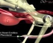 Vet Stent - Urethra Placement from urethra