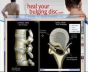 http://www.healyourbulgingdisc.comnnIn this video, Dr. Ron Daulton, Jr. discusses what a ruptured disc is, the symptoms that are associated with it, and some of the treatment options available.This condition is also referred to as a Sequestered Disc.For more information, visit the link above.nnhttp://www.youtube.com/watch?v=YUcpba2-1vY