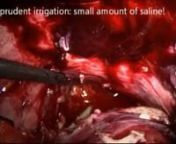 This video details laparoscopic drainage of an abscess in patient who had recently undergone (laparoscopic converted to open) appendicectomy for perforated appendicitis. The abscess was not amenable to percutaneous radiological drainage. The video is associated with a manuscript that has been submitted for publication in Colorectal Disease (http://onlinelibrary.wiley.com/journa...). Click Subscribe to this channel for the most up-to-date content!nnOperating Surgeon: Dr Salomone Di Saverio MD FAC