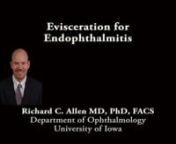 This is Richard Allen at the University of Iowa.This video demonstrates an evisceration in a patient with endophthalmitis.Due to the significant inflammation in this case and tendency for bleeding due to the inflammation, a retrobulbar block and subconjunctival injection are placed with lidocaine and bupivacaine with epinephrine.The Westcott scissors are used to perform a 360 degree peritemy.There is often a bit of oozing, which in general can be ignored as it will stop.A supersharp bl