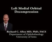 This is Richard Allen at the University of Iowa.This video demonstrates a left medial wall decompression through a transcaruncular incision.An Incision is made with Westcott scissors between the caruncle and the plica. This incision extends both superiorly and inferiorly.Steven scissors are then used to bluntly dissect in the direction of the posterior lacrimal crest.A malleable retractor is then used to visualize the medial orbital wall.A desmarres retractor can be placed medially in