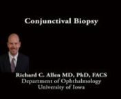 This is Richard Allen at the University of Iowa.This video demonstrates a conjunctival biopsy.This patient has a history of idiopathic cicatricial changes and specimens for both histopathology and immunopathology are being taken.The palpebral conjunctival is exposed and a specimen is taken from the area between the inferior border of the tarsus and the fornix. This biopsy can be taken with toothed forceps and Westcott scissors. The specimen is then placed on filter paper so that it remains