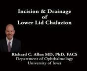 This is Richard Allen at the University of Iowa. This video demonstrates incision and drainage of a right lower lid chalazion. The chalazion is palpated and is noted to be internal.The area is then marked.The area is marked because subsequent infiltration with local anesthetic can sometimes make the chalazion difficult to palpate.The area is infiltrated with local anesthetic.The area is then prepped with betadine.A chalazion clamp is placed over the area.This will be drained from the