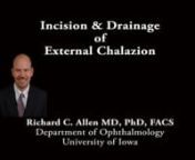 This is Richard Allen at the University of Iowa.This video demonstrates treatment of an external chalazion of the left lower lid.A chalazion clamp is placed over the lesion and the chalazion will be approached externally due to the anterior positioning of the lesion and the thinness of the skin over the lesion.An 11 blade is then used to make a horizontal incision through the skin over the lesion.A chalazion curette is used to gently express any of the internal portion of the chalazion.