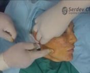 This is a trailer for the scarless Serdev Suture® Lower Face &amp; Neck Lift instructional video.