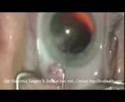 Eye Glaucoma Surgery from get plastic surgery for free