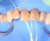 Rubber dam isolation for anterior composite restorations.Step by step technique. Inversion using air and dental floss knot.