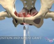 If you want to see samples of how the animation that Ghost Productions creates can be used to explain reproductive and urological anatomy and surgical devices, then you&#39;ve come to the right place.