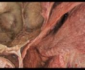 Video 1. Video showing the anatomical dissection and 3D cadaveric rendering of multiport EEA/CTM and EEA/cMTO to the contralateral skull base. © Jaskaran S. Gosal, published with permission.nhttps://thejns.org/doi/10.3171/2024.1.FOCUS23863