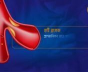 CSICON-307086-Angioplasty-Bengali-Dr. G S Suresh Babu from bengali babu
