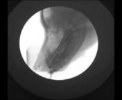 Contrary to published accounts, dogs do not simply scoop liquids into their mouths with the spoon-shaped cavity that forms in the ventral surface of their backwardly directed tongue tip.As in cats, an aliquot of liquid adheres to the dorsal surface of the tongue tip and is transported into the oral cavity as the tongue is rapidly withdrawn.Video-fluoroscopy recordings indicate that at least three lapping cycles are needed to transport liquid to and through the oral cavity.