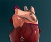 An excerpt of the video created for one of our clients. This is a 3D medical animation of AFib. AFib is a abnormal heartbeat (arrhythmia). It often starts as small periods of abnormal beating which become possibly constant and longer over time. Its symptoms may be heart palpitations, fainting, shortness of breath, or chest pain. It can lead to blood clots, stroke, heart failure, etc. Hypertension and valvular heart disease are the most common alterable risk factors for AF. Check http://www.scien
