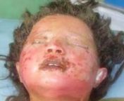Behold the effect of white phosphorus bombing on a young child’s skin. In May 2009, Afghan lawmaker Obaidullah Helali, who headed a delegation investigating this massacre from US bombing in the western province of Farah, confirmed that it took the lives of 95 children…nnThe talk from Malalai Joya was recently hosted in Sydney by Pip Hinman on behalf of the Stop The War Coalition - stopwarcoalition.org - and chaired by Kellie Tranter, lawyer and human rights activist. The visual material come