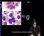 Leukemia and lymphoma L-1 \ \pathology from mon l lyrieal l to