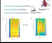 A spectrogram is a visual representation of the spectrum of frequencies of a signal as it varies with time. &#60;br/&#62;Quantitative analysis of an auscultation signal can aid physicians to identify abnormal heart condition. &#60;br/&#62;This project aims at using the auscultation signal from a normal patient( with no heart conditions) and compares with a PDA (Patent Ductus Arteriosus) patient. &#60;br/&#62;&#60;br/&#62;There is a difference in their respective spectrogram and can be used by physicians to accurately diagnose any heart condition. &#60;br/&#62;&#60;br/&#62;#digitalsignalprocessing #signalprocessing #signals_systems #matlab #engineeringprojects #audioprocessing #spectrogram